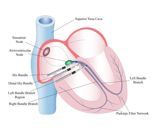 Understanding Conduction System Pacing: A New Hope for Heart Patients