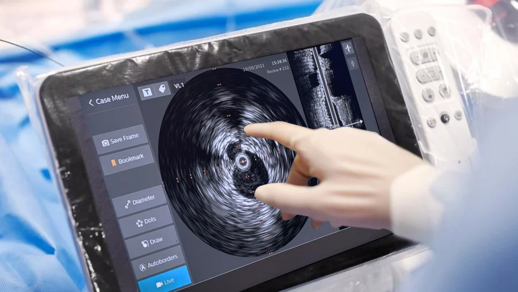 Heart patients in India have access to advanced techniques such as IVUS