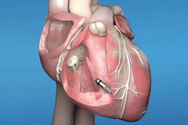 Dr. Dhananjay Kumar: Pioneer of Leadless Pacemaker Technology in Bihar & Jharkhand