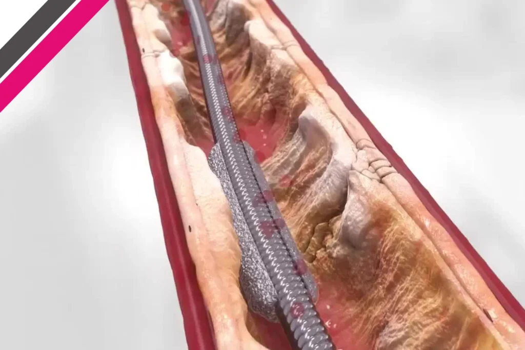 Orbital Atherectomy: Advanced Calcium Modification for Complex Coronary Blockages