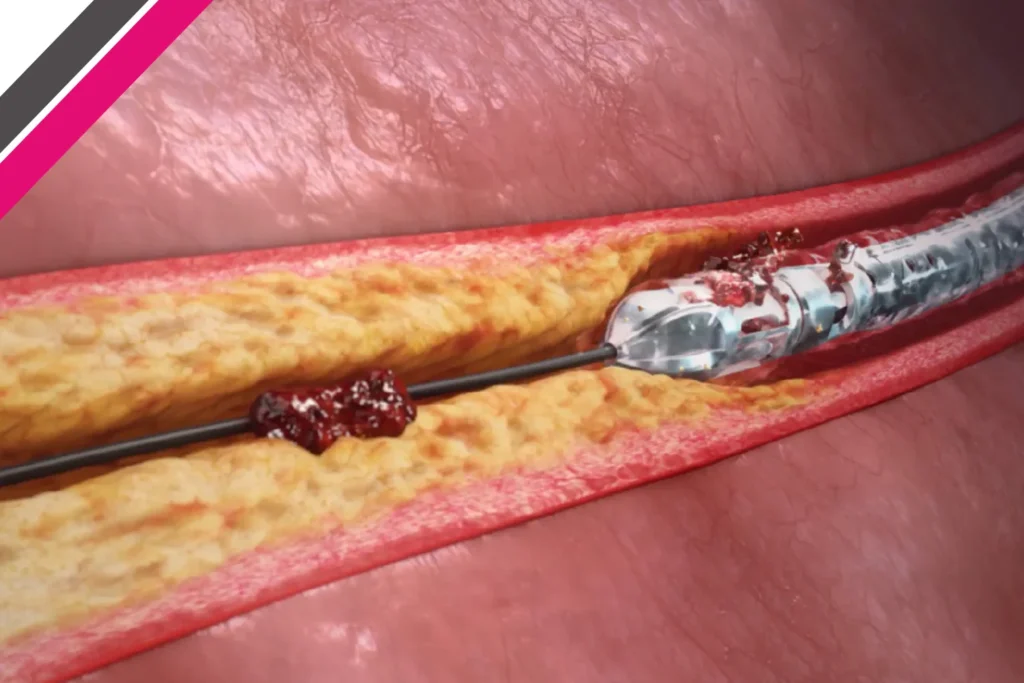 Rotational Atherectomy: Advanced Treatment for Heavily Calcified Coronary Blockages