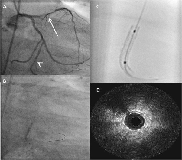 Dr. Dhananjay Kumar – Pioneer of Zero Contrast Angioplasty in Bihar & Jharkhand
