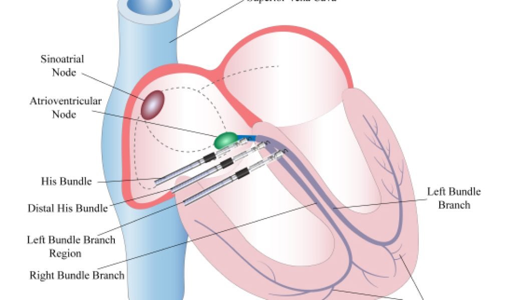 Evaluating-Physiological-Pacing