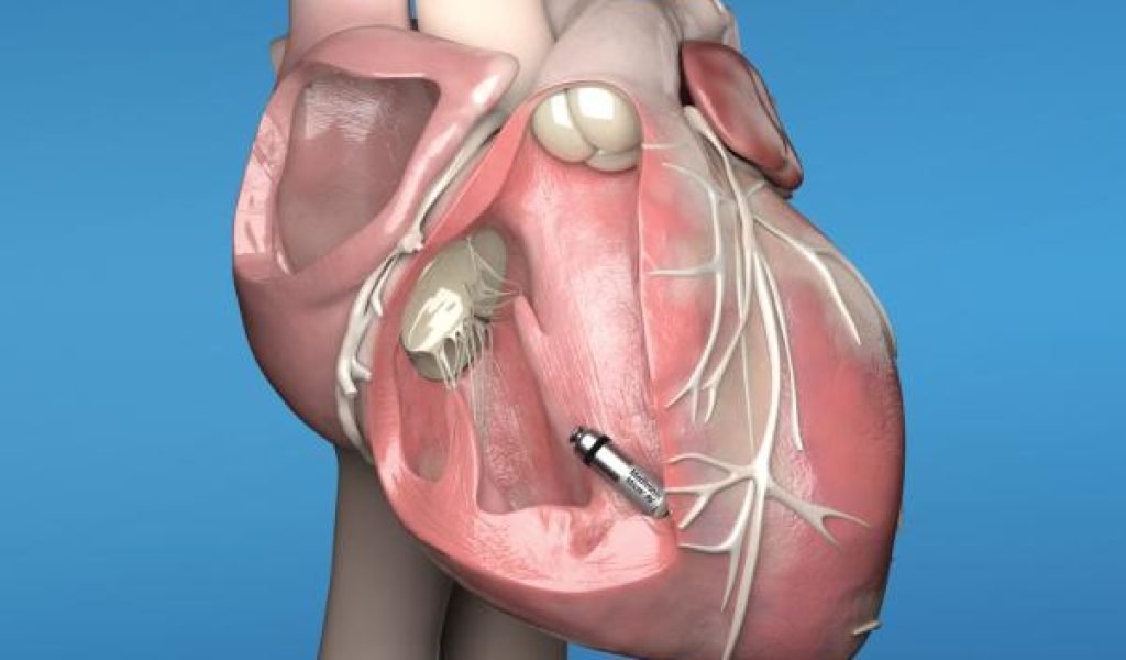 Micra-AV-in-heart_Medtronic Cropped