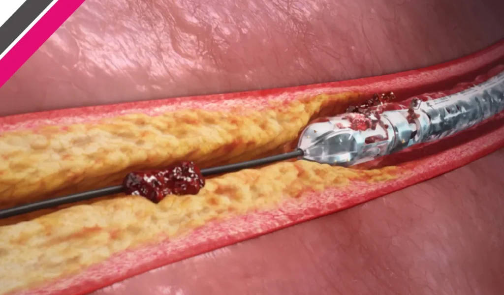 Rotational-Atherectomy