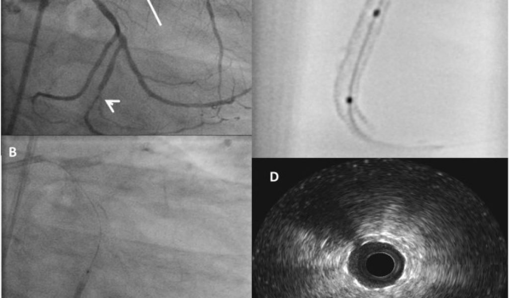 angioplasty